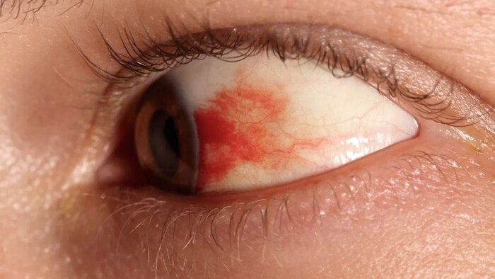 Alimentos clave para prevenir la retinopatía diabética y proteger la salud ocular