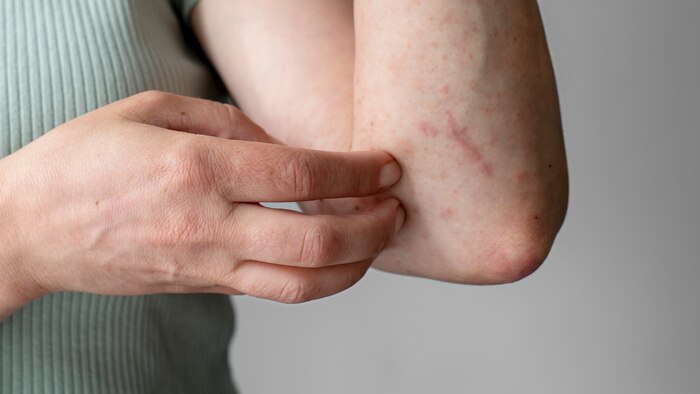 Dermatitis atópica: estrategias para prevenir brotes de eczema y mantener la piel saludable