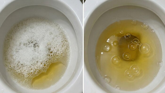 Espuma y burbujas en la orina: causas, diferencias y su relación con enfermedades renales