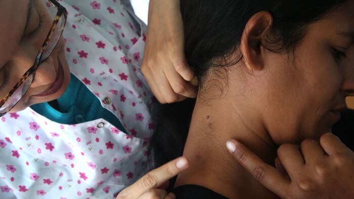 Estudio revela altas tasas de diagnóstico tardío y baja supervivencia en casos de melanoma en Perú