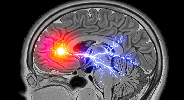 Innovación tecnológica y gestión de riesgos transforman el tratamiento de la epilepsia en México