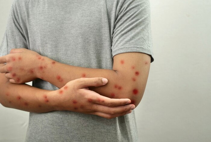 México registra más de 9,4 mil casos de sarampión y 29 muertes en siete estados